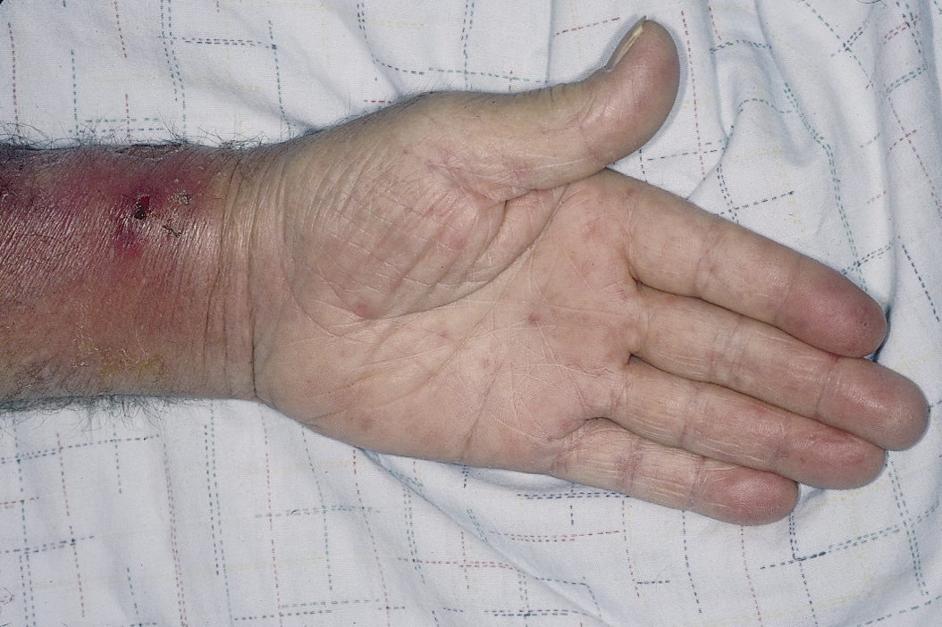 Janeway Lesion: Flat, painless, erythematous lesions seen on the palm of this patient's hand. While frequently associated with bacterial endocarditis, in this case, they are the result of an infected radial artery aneurysm (inflamed area proximal to thumb).