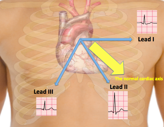 The normal axis of the heart lies between -30 and +90 degrees. A positive deflection wave is noted in leads I, II and III