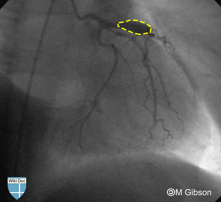 File:Coronary artery aneurysm static.gif