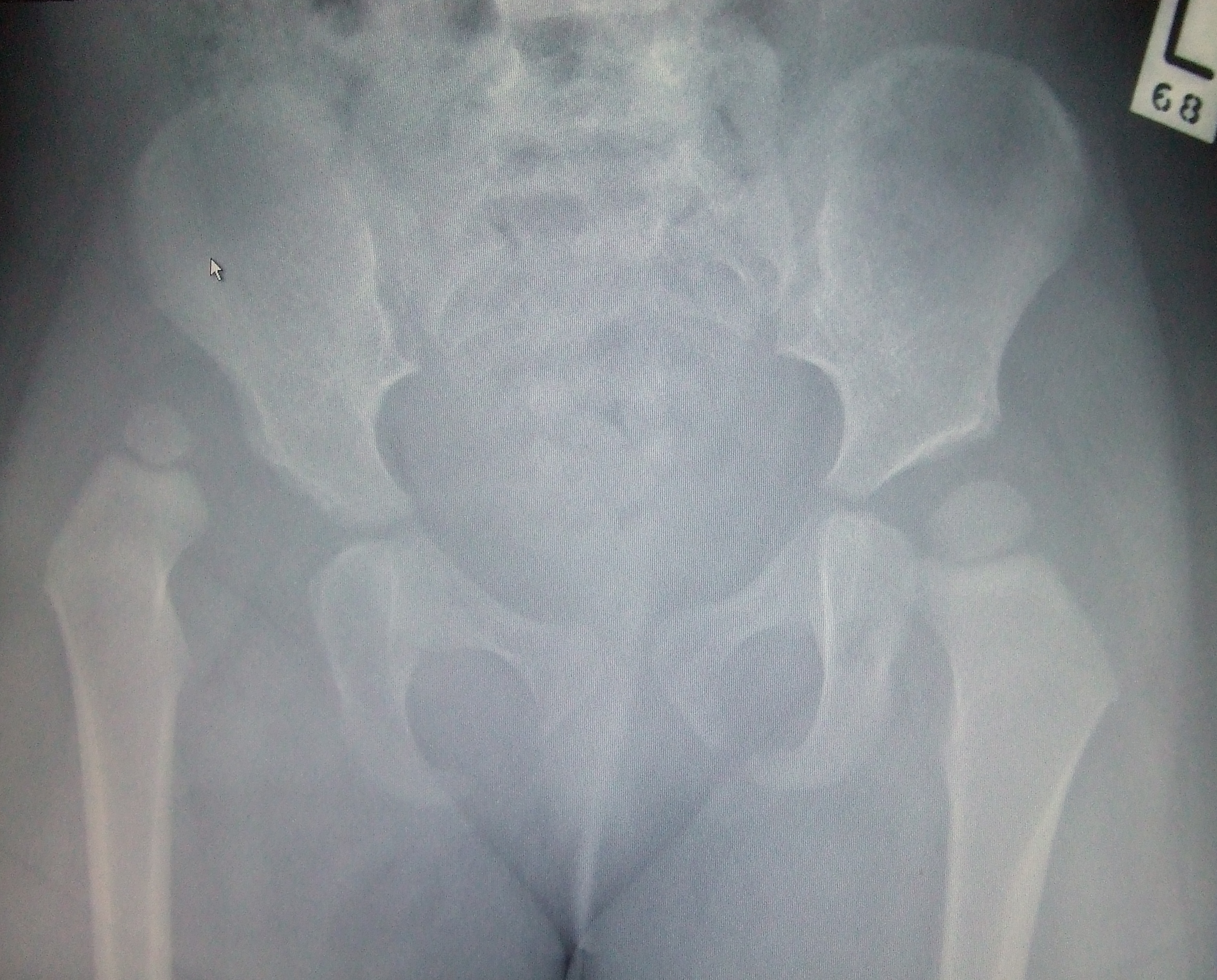 X-Ray Image showing Hip Dysplasia in an Infant