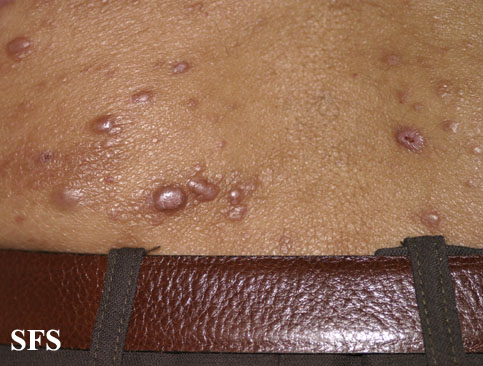 Lepromatous leprosy. Adapted from Dermatology Atlas.[5]
