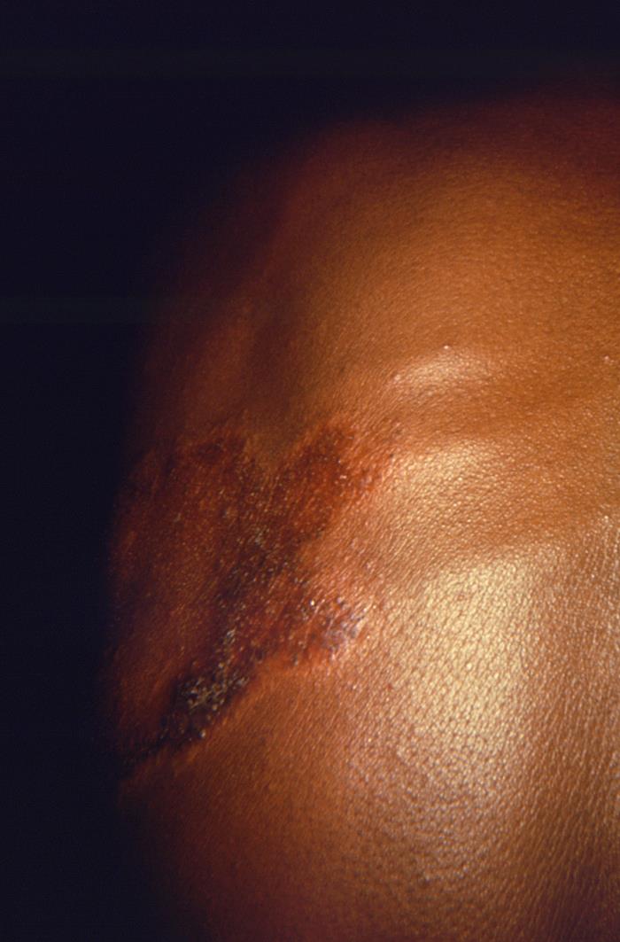 Inflammatory cutaneous lesion on the thorax classifies as tuberculoid, paucibacillary form of leprosy. Adapted from Public Health Image Library (PHIL), Centers for Disease Control and Prevention.[6]