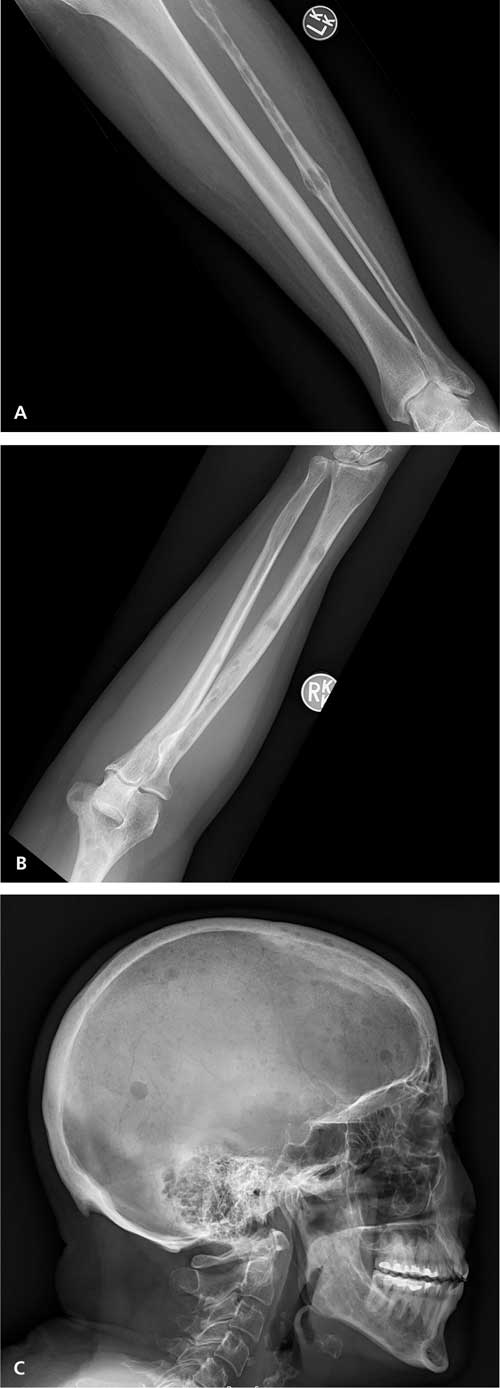 File:Lytic lesion in right forearm.jpg