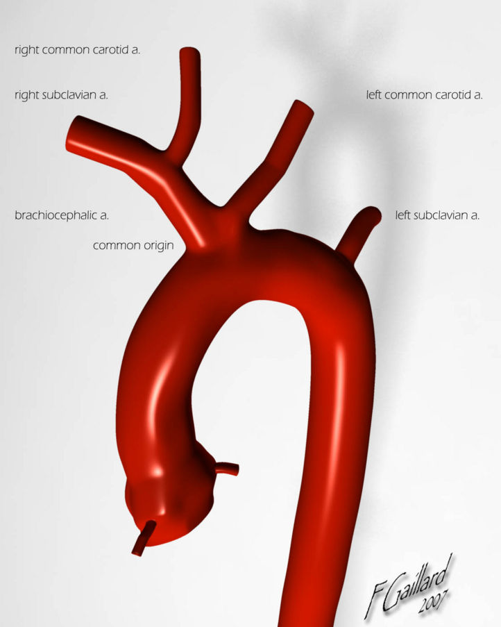 Aortic arch anomalies classifications bovine arch - wikidoc