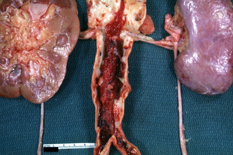 Thrombus: Gross natural color aorta with kidneys showing thrombotic occlusion due to atherosclerosis beginning just below renal arteries and extending into common iliac (very good example)