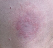 Characteristic "bulls-eye"-like rash caused by Lyme disease - Source: WIKICOMMONS