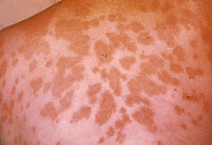 File:Valley fever skin lesions.jpg