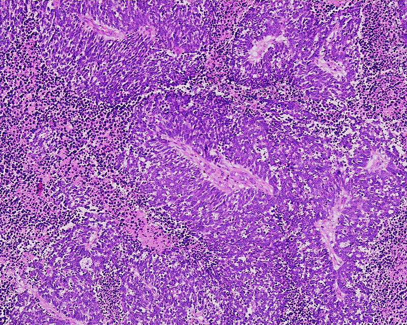 Anaplastic (microcellular, oat cell) carcinoma from the lung.