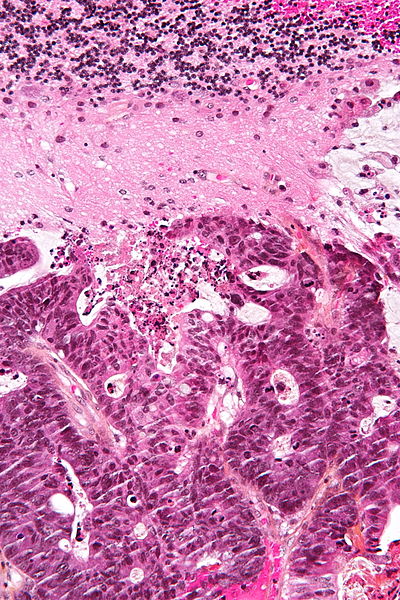 High magnification micrograph demonstrating metastatic adenocarcinoma that is from a colorectal primary, i.e. colorectal carcinoma, by immunostains on HPS stain. The cerebellum has Bergmann gliosis and Purkinje cell loss.[10]