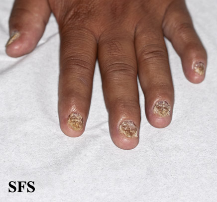 Nails showing pitting, crumbling and brittleness, courtesy of http://www.atlasdermatologico.com.br/