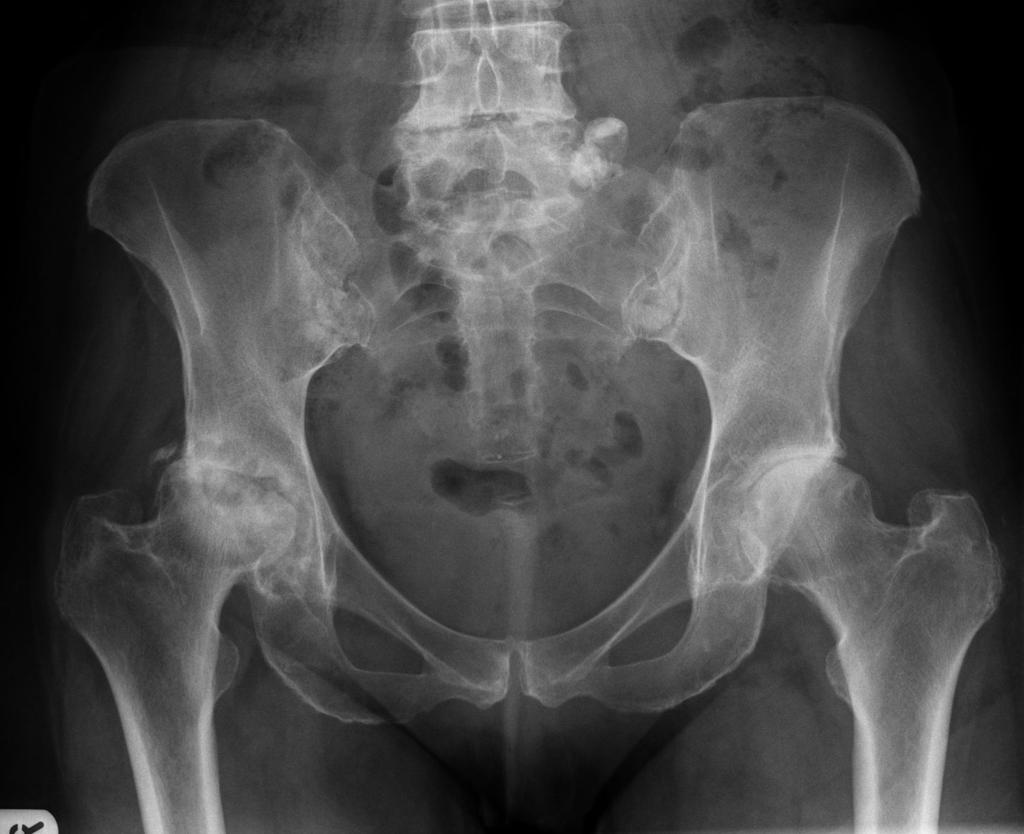 File:Radiopedia-hip-osteoarthritis.jpg