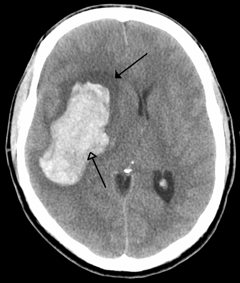 File:Stroke CT01.png