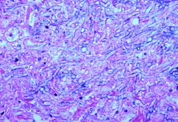 Note the histopathologic changes seen in aspergillosis of the lung of a caged parrot using H&E stain, which shows fungal hyphae. From Public Health Image Library (PHIL). [1]