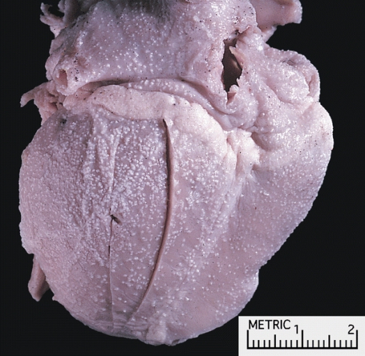 Cardiac rhabdomyoma: Note the multiple, minute tumors studding the epicardial surface. This pattern of involvement is typical in patients with tuberous sclerosis.