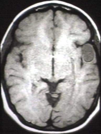 MRI of ganglioglioma