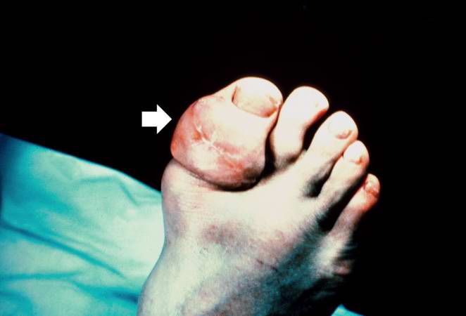 File:Gout case 8.jpg