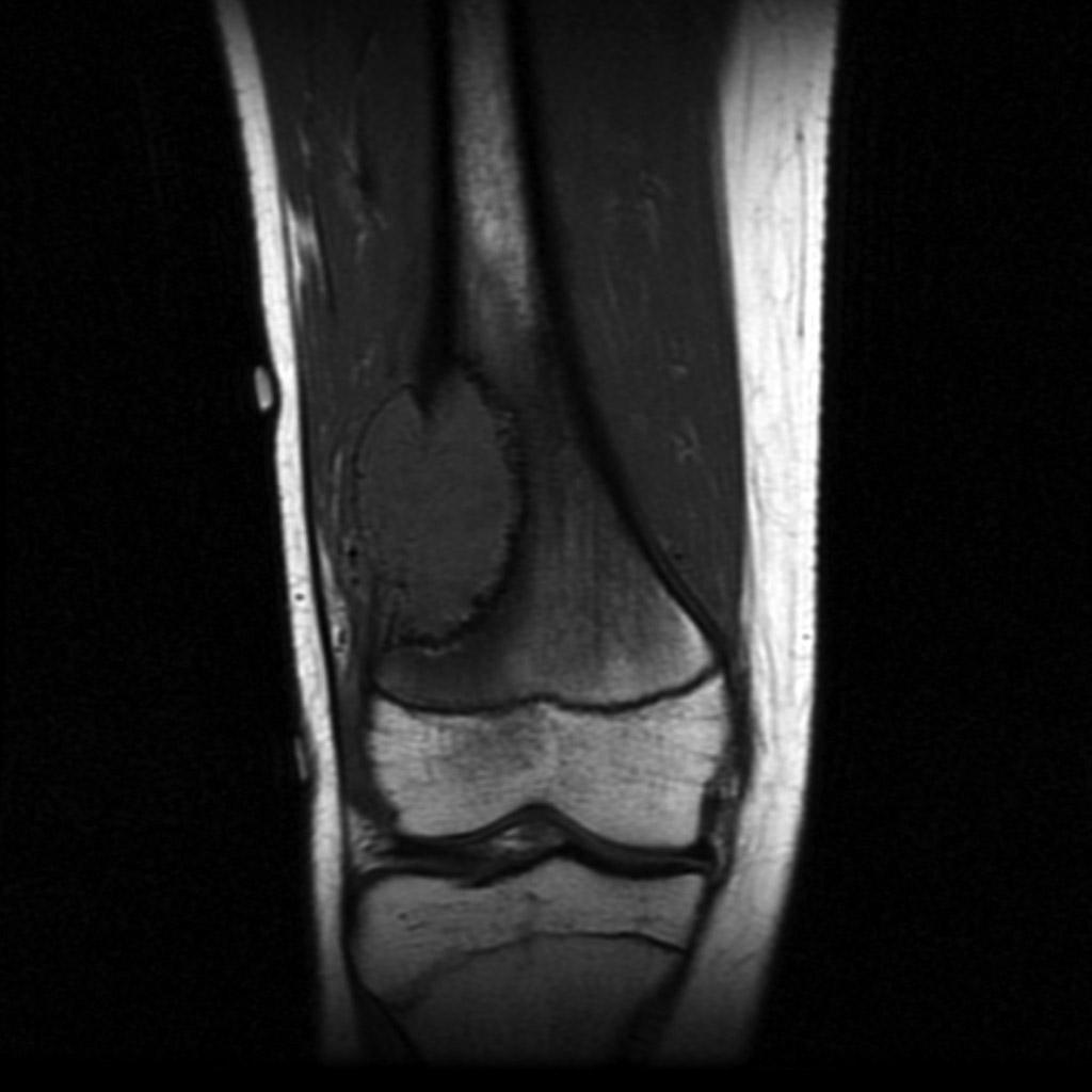 Osteosarcoma of femur MRI T1[2] http://radiopaedia.org/articles/osteosarcoma