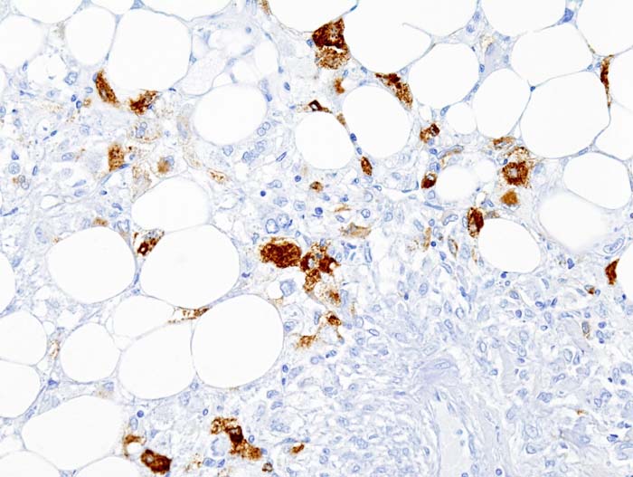 Histopathologic image of renal angiomyolipoma. Nephrectomy specimen. HMB-45 immunostain.[8]