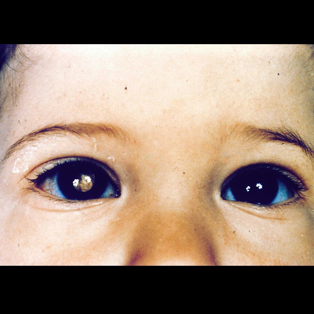 File:Retinoblastoma leukocoria.jpeg