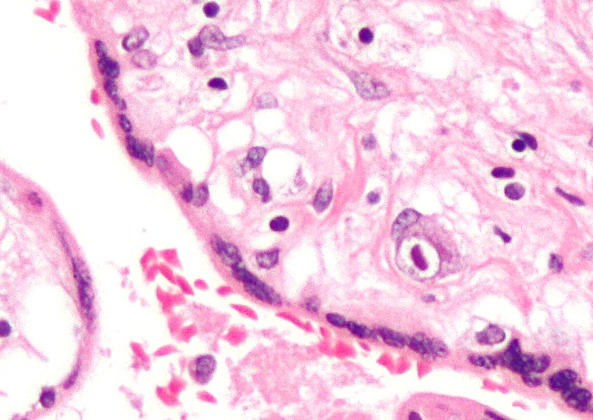 Microscopic pathology of CMV placentitis on H&E staining showing CMV-infected cells