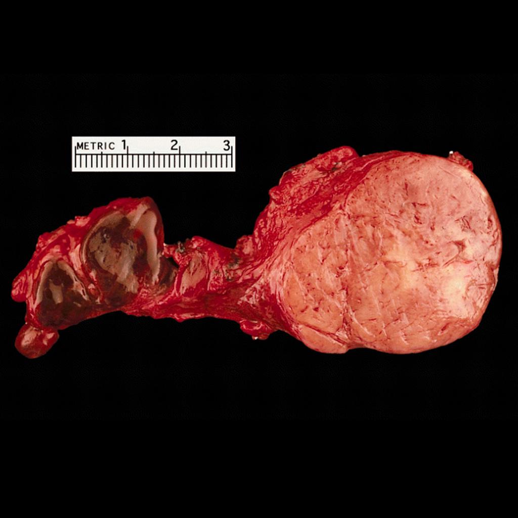 Gross pathology of carotid body tumor[12]