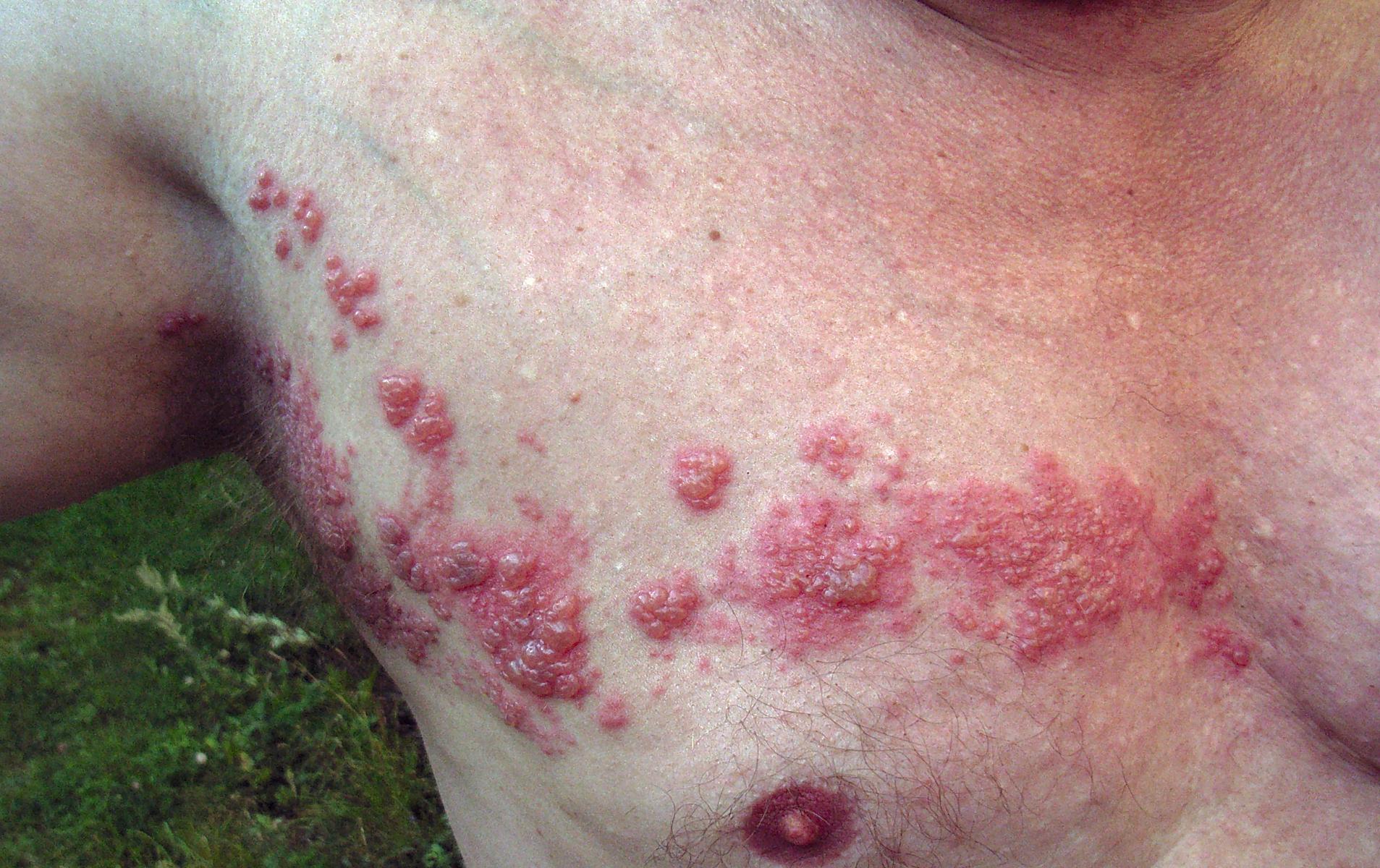 Herpes zoster on the chest