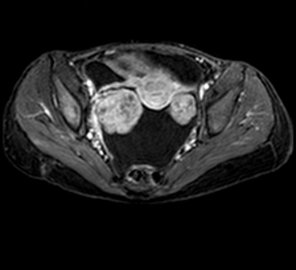 Axial T1 C+ fat sat dynamic contrast study image[8]