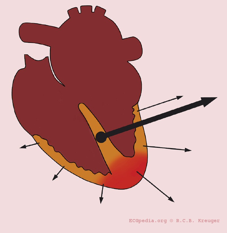 Heart axis deviation to the left in case of an inferior myocardial infarction. Left anterior hemiblock is a common cause. A left axis is between -30 and -90 degrees. The axis is -30 degrees.