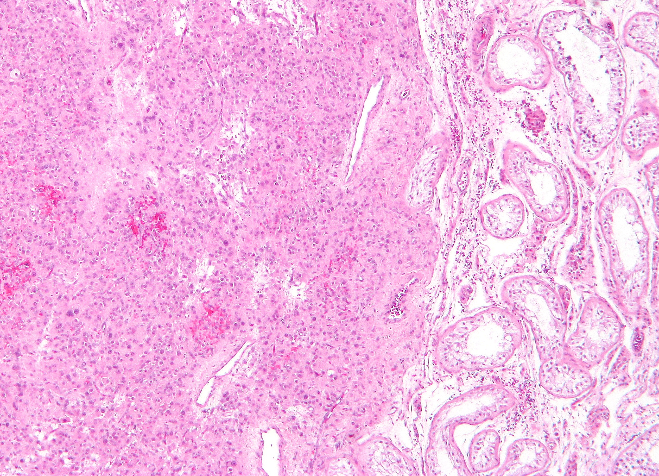 File:Leydig cell tumour1.jpg