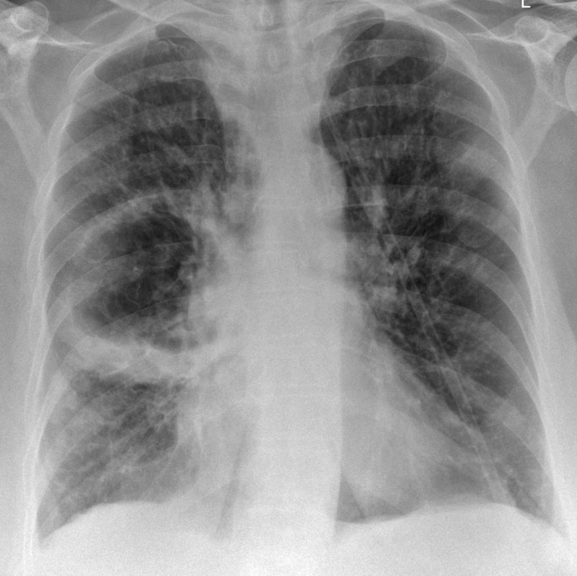 File:Lung abscess chest xray.gif