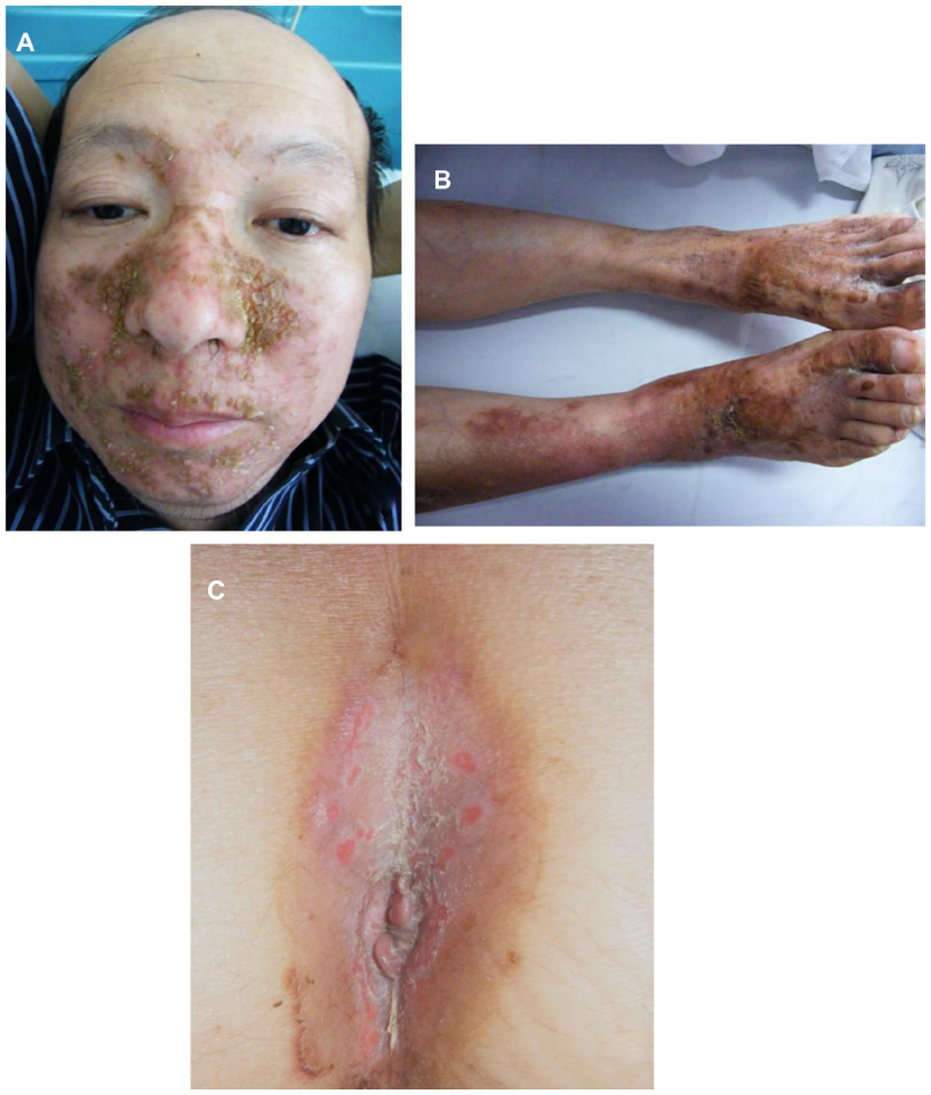 Necrolytic migratory erythema with erosion and crust formation[4]