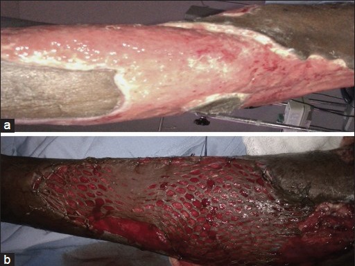 (a) Necrotising fasciitis leg, after initial debridement. (b) after application of meshed split skin graft[13]