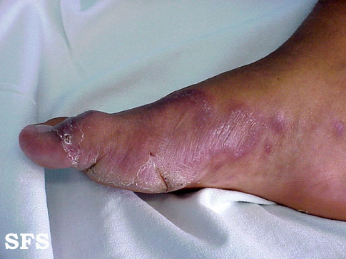File:Tuberculoid leprosy14.jpg