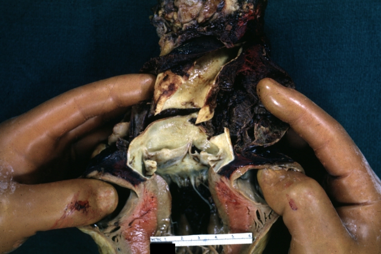 Dissecting Aneurysm: Gross dissection first portion of arch fixed specimen (a good example).