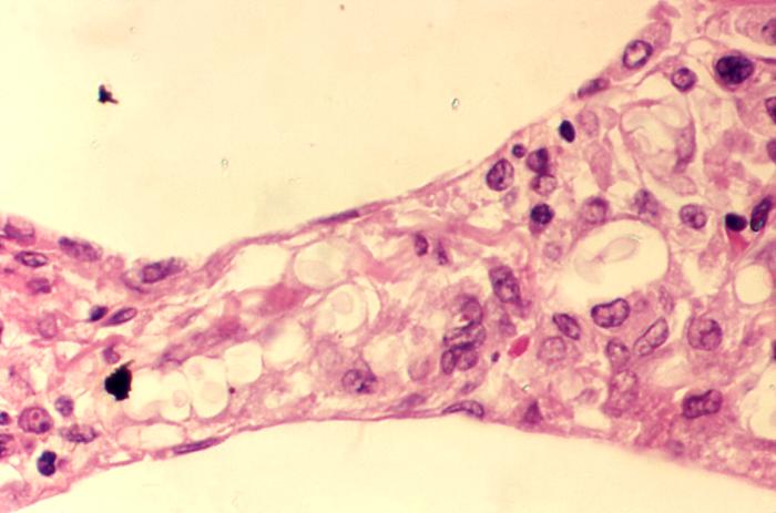 Cryptococcosis of lung in patient with AIDS. From Public Health Image Library (PHIL). [7]