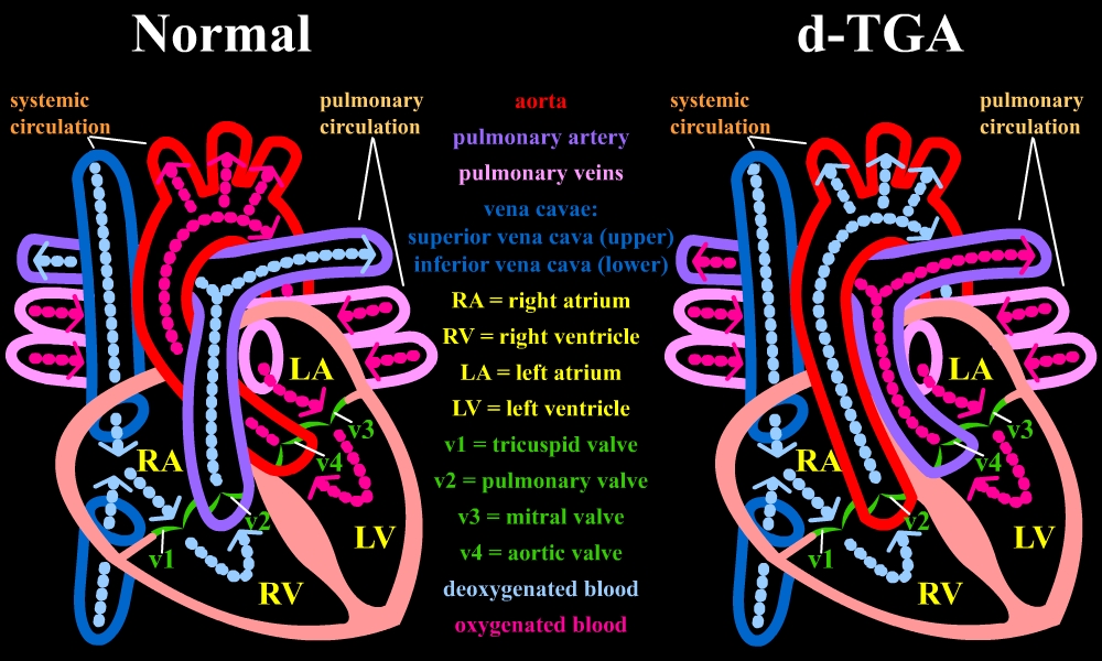 Dextro-transposition of the great arteries pathophysiology - wikidoc