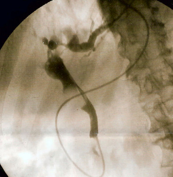 Fluoroscopic image of common bile duct stone seen at the time of ERCP. The stone is impacted in the distal common bile duct.