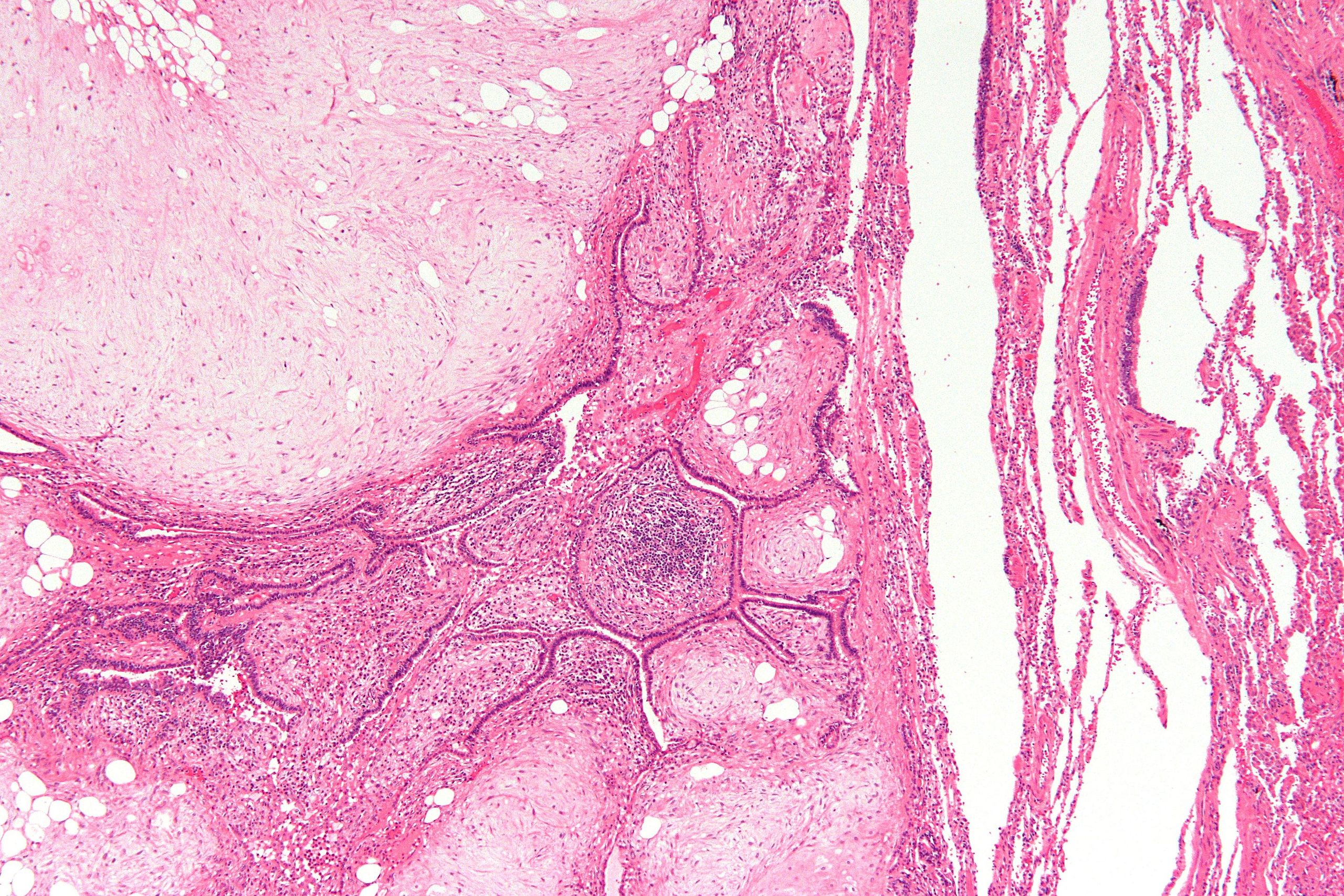 Low magnification micrograph of a pulmonary hamartoma. H&E stain.[9]