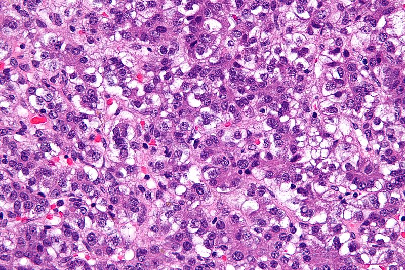 File:Hepatoblastoma microscopy1.jpg