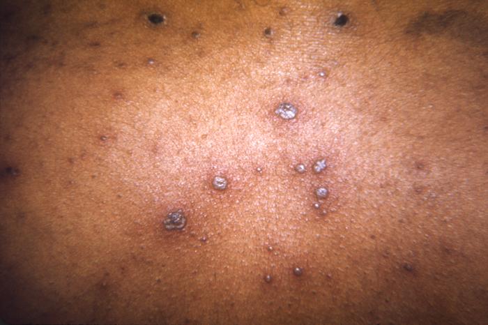 This 1968 image depicted a number of varicella, or chickenpox lesions on a patient’s back, which were displaying the characteristic “cropping” distribution, or manifesting themselves in clusters, each in a different developmental stage.