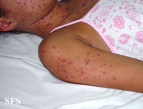 Lupus erythematosus-systemic. Adapted from Dermatology Atlas.[30]