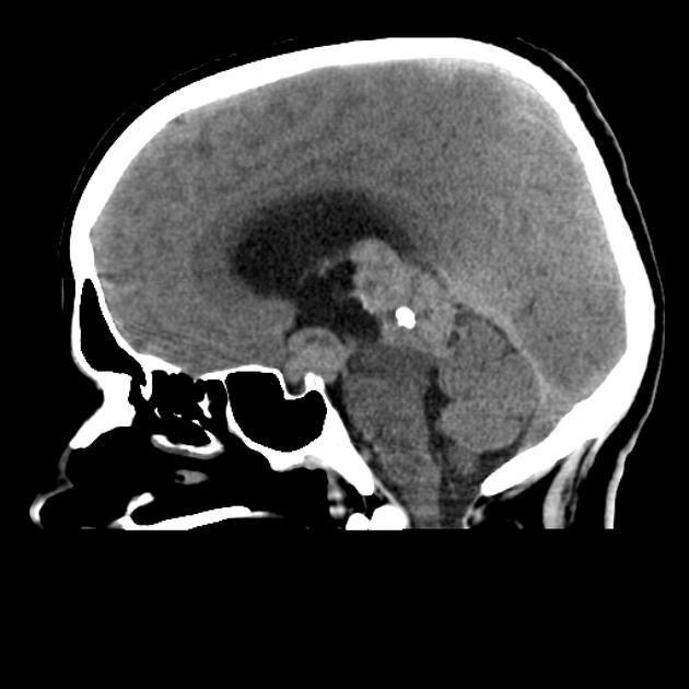 Sagittal non contrast CT of germinoma of CNS[2]