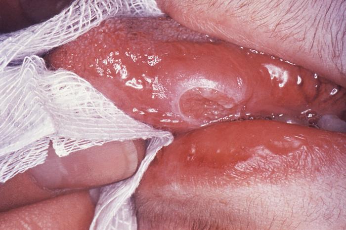 Left lateral margin of a tongue of a tuberculosis patient, which had been retracted in order to reveal the lesion that had been caused by the Gram-positive bacterium Mycobacterium tuberculosisAdapted from Public Health Image Library (PHIL), Centers for Disease Control and Prevention.[23]