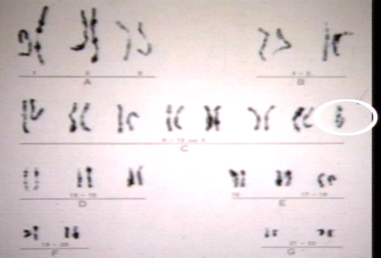 Turner's karyotype.