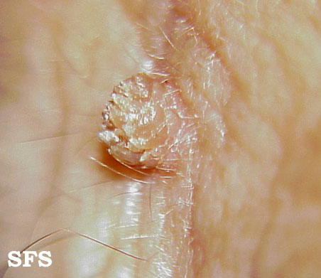 Warts filiformis. Adapted from Dermatology Atlas.[1]