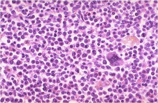 Bone marrow biopsy in acute leukemia