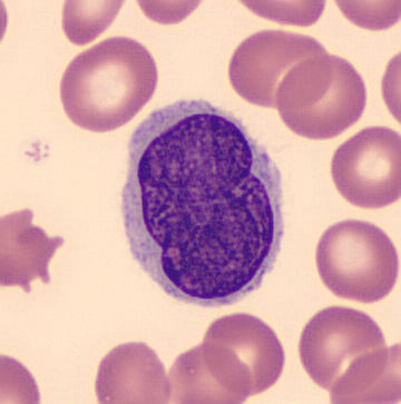Pleomorphic abnormal T cell with the characteristic cerebriform nuclei (Peripheral blood - MGG stain)