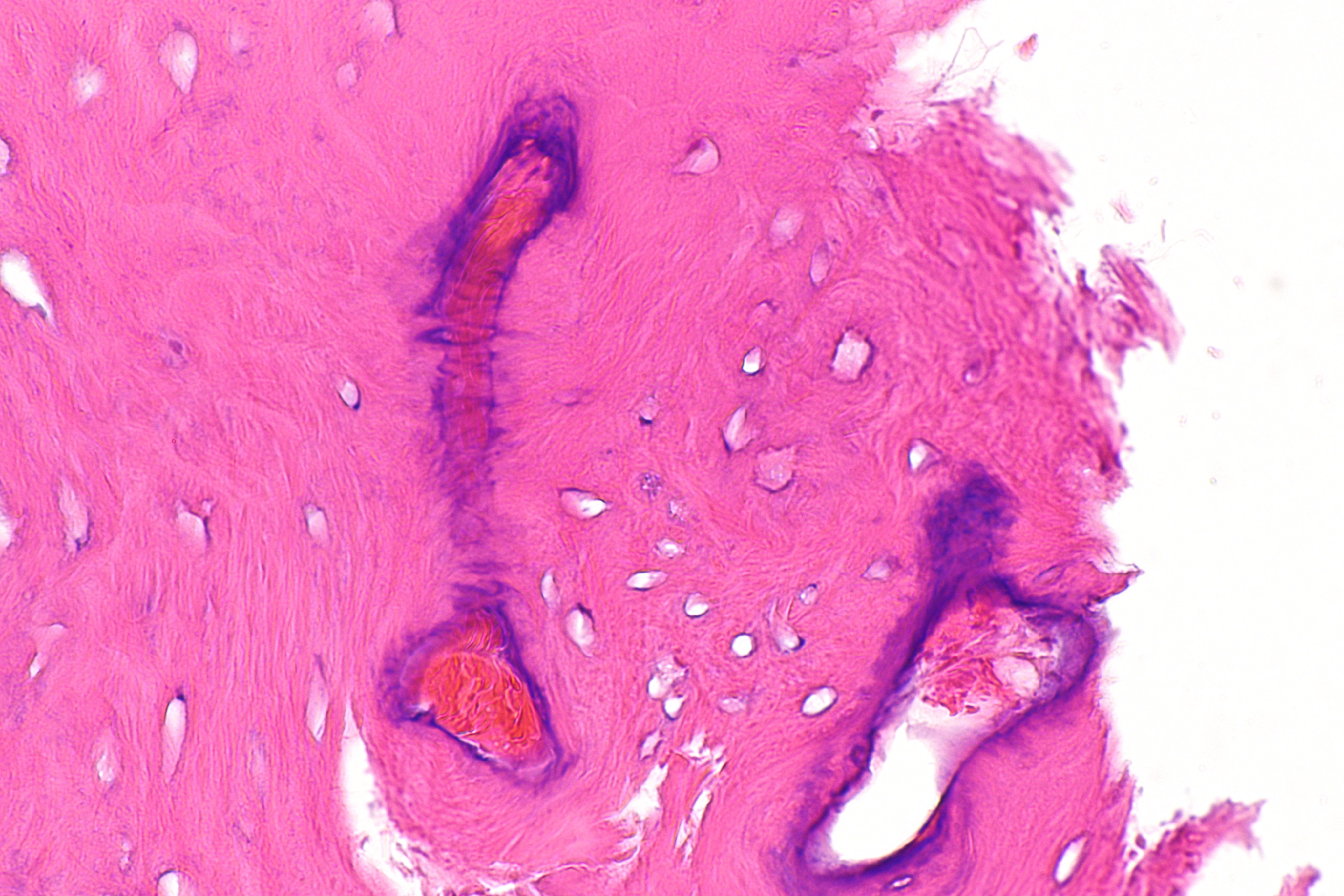 File:Histology osteoma.jpg
