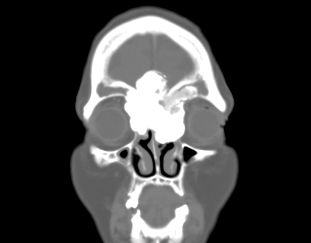 Coronal view exophytic osteoma [1]
