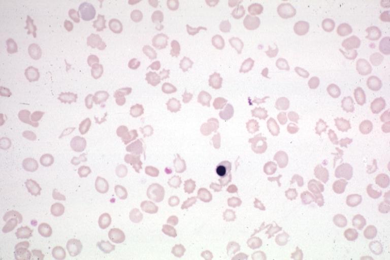 Blood: Schistocytes: Micro blood film shows an excellent example with normoblast.